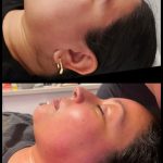 doublechinfatreduction